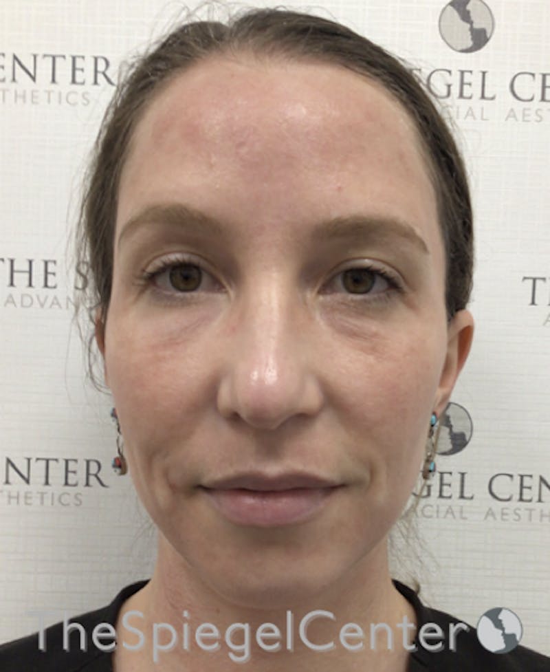 Morpheus8 Before & After Gallery - Patient 146107 - Image 3