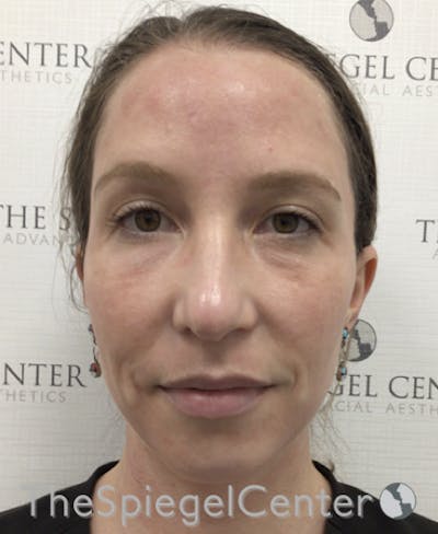 Morpheus8 Before & After Gallery - Patient 146107 - Image 3