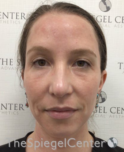 Morpheus8 Before & After Gallery - Patient 146107 - Image 3