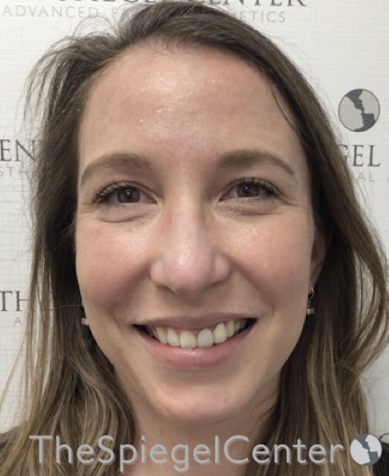 Morpheus8 Before & After Gallery - Patient 146107 - Image 4