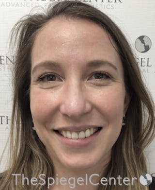 Morpheus8 Before & After Gallery - Patient 146107 - Image 4