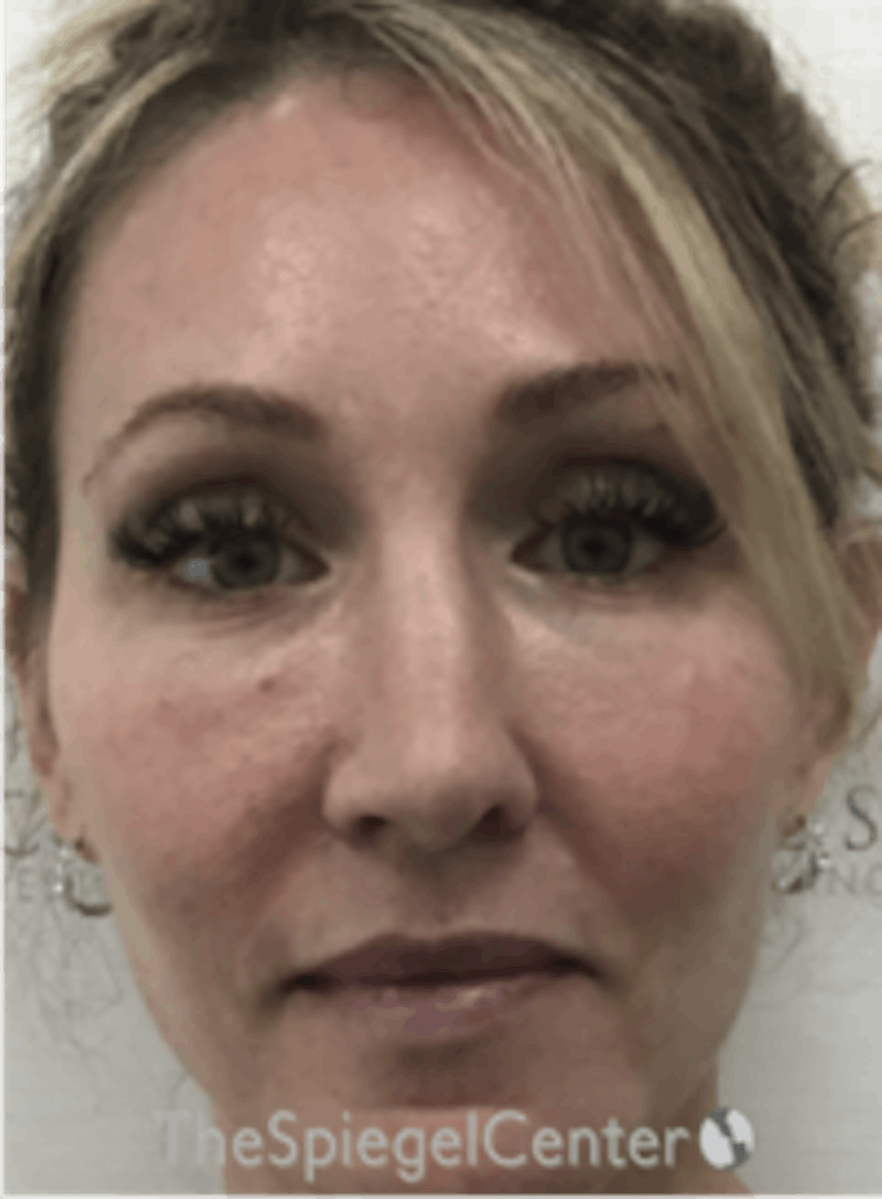 Morpheus8 Before & After Gallery - Patient 292968 - Image 1