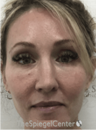 Morpheus8 Before & After Gallery - Patient 292968 - Image 1