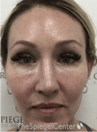 Morpheus8 Before & After Gallery - Patient 292968 - Image 2