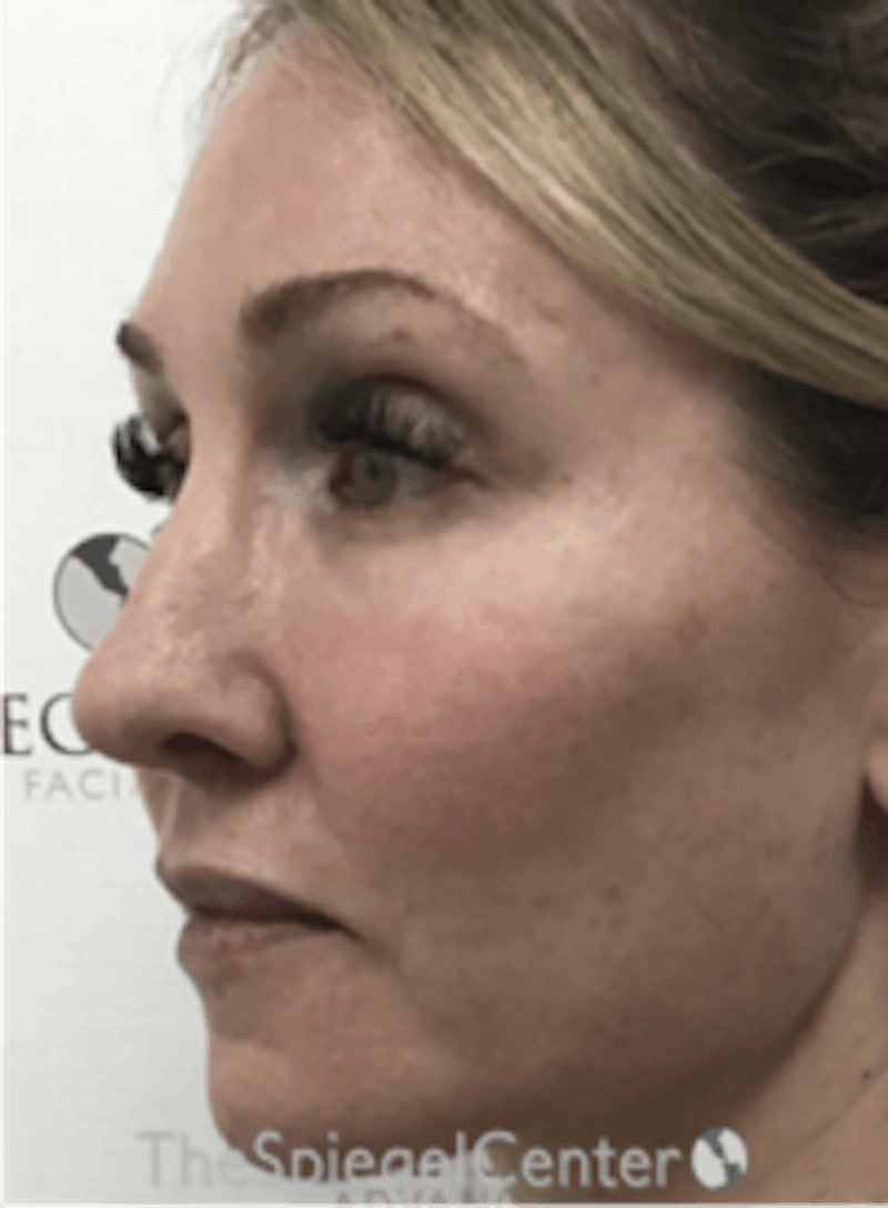 Morpheus8 Before & After Gallery - Patient 292968 - Image 3