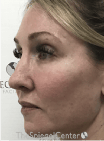 Morpheus8 Before & After Gallery - Patient 292968 - Image 3