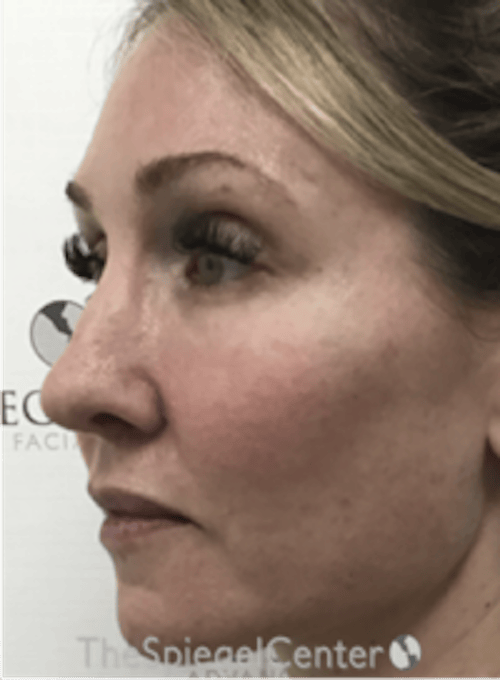 Morpheus8 Before & After Gallery - Patient 292968 - Image 3