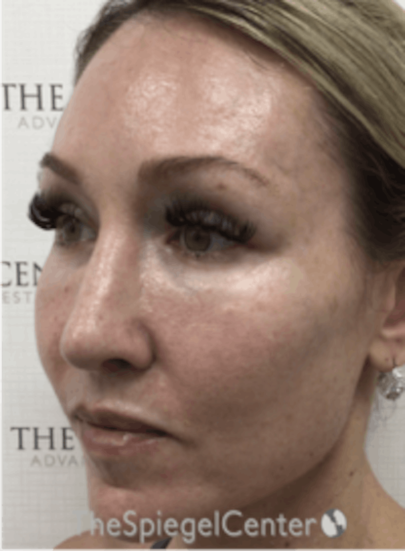 Morpheus8 Before & After Gallery - Patient 292968 - Image 4