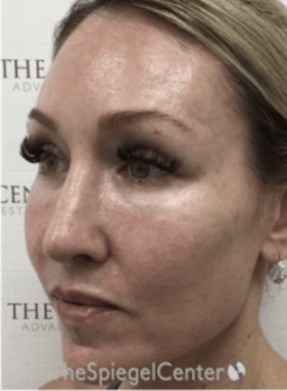 Morpheus8 Before & After Gallery - Patient 292968 - Image 4