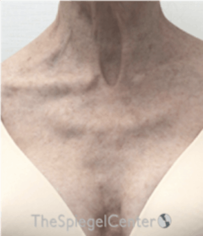 Morpheus8 Before & After Gallery - Patient 179081 - Image 1