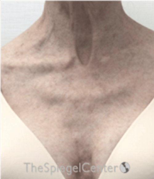 Morpheus8 Before & After Gallery - Patient 179081 - Image 1