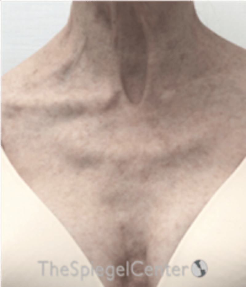 Morpheus8 Before & After Gallery - Patient 179081 - Image 1