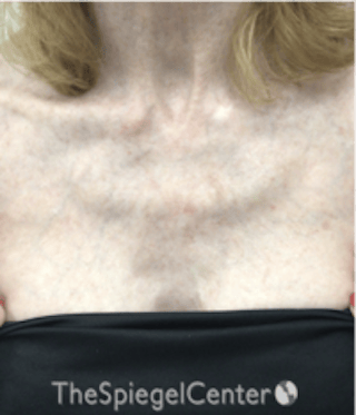 Morpheus8 Before & After Gallery - Patient 179081 - Image 2