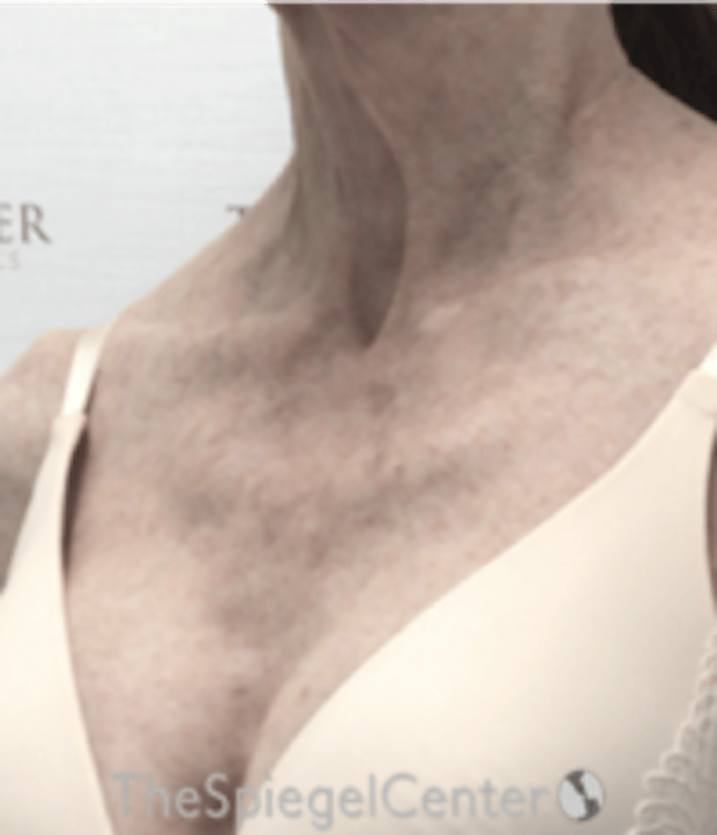 Morpheus8 Before & After Gallery - Patient 179081 - Image 3