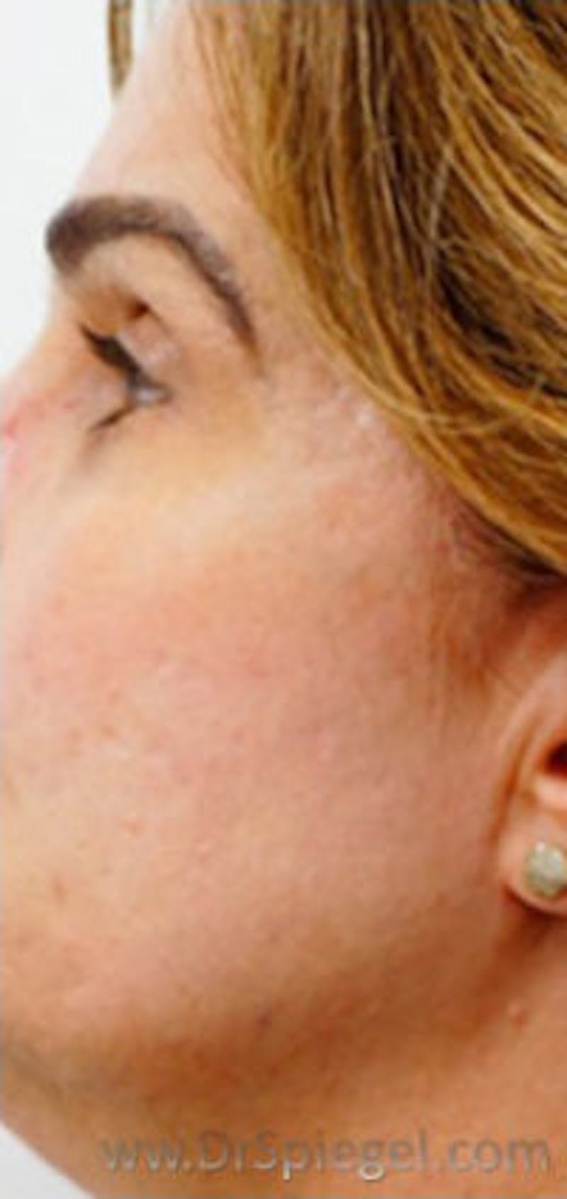 Morpheus8 Before & After Gallery - Patient 413882 - Image 1