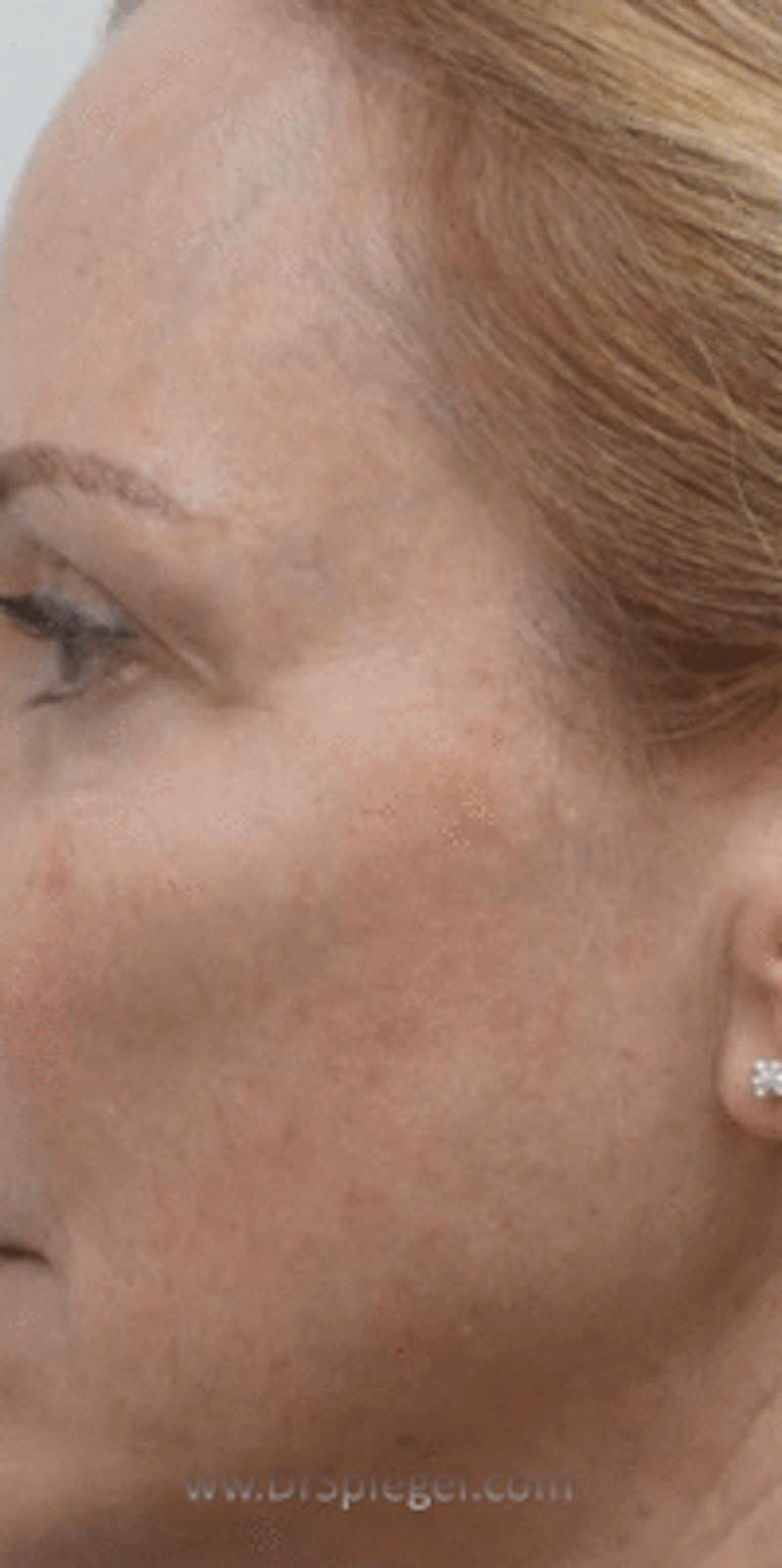 Morpheus8 Before & After Gallery - Patient 175636 - Image 1