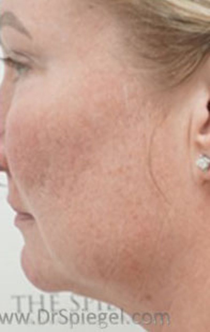 Morpheus8 Before & After Gallery - Patient 313050 - Image 1