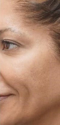 Morpheus8 Before & After Gallery - Patient 394731 - Image 1