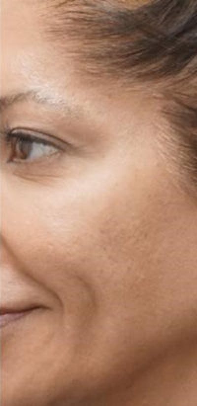 Morpheus8 Before & After Gallery - Patient 394731 - Image 1