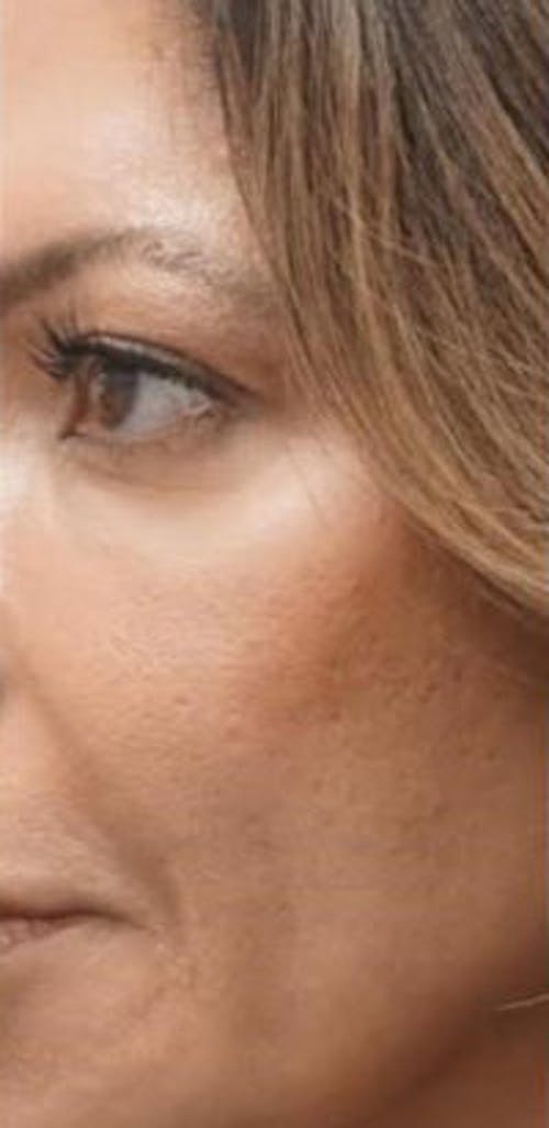 Morpheus8 Before & After Gallery - Patient 394731 - Image 2