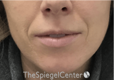 Nasolabial Fold Filler Before & After Gallery - Patient 309056 - Image 1