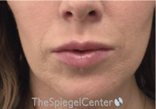Nasolabial Fold Filler Before & After Gallery - Patient 309056 - Image 2