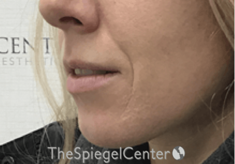 Nasolabial Fold Filler Before & After Gallery - Patient 309056 - Image 3
