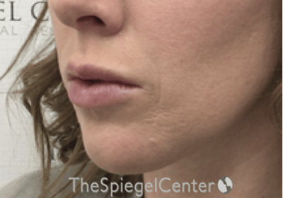 Nasolabial Fold Filler Before & After Gallery - Patient 309056 - Image 4