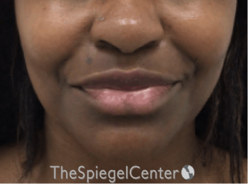 Nasolabial Fold Filler Before & After Gallery - Patient 117666 - Image 1