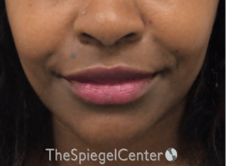 Nasolabial Fold Filler Before & After Gallery - Patient 117666 - Image 2