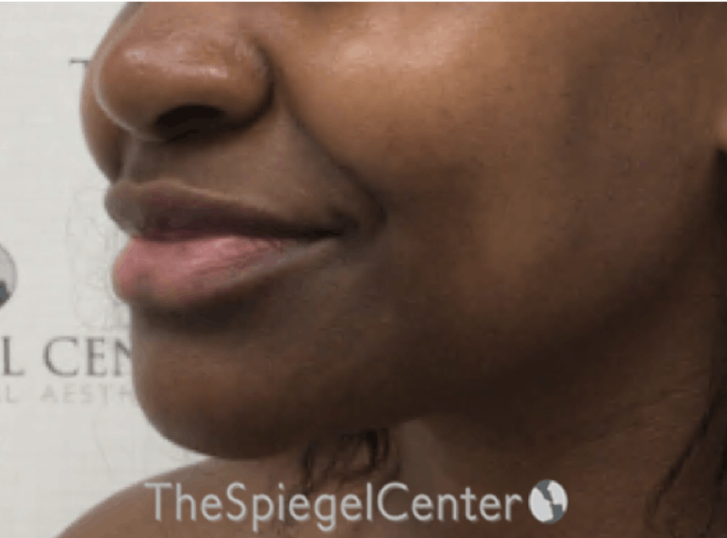 Nasolabial Fold Filler Before & After Gallery - Patient 117666 - Image 3