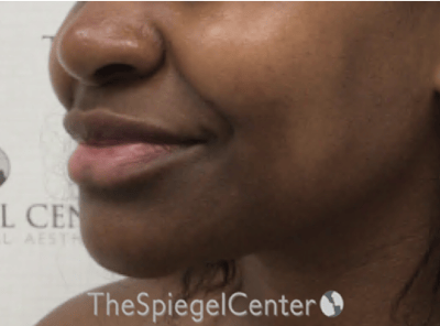 Nasolabial Fold Filler Before & After Gallery - Patient 117666 - Image 3