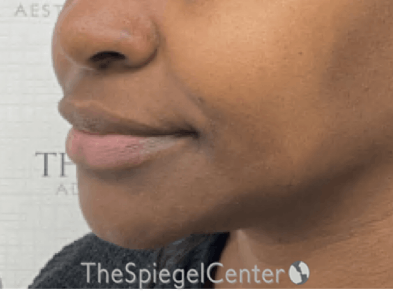Nasolabial Fold Filler Before & After Gallery - Patient 117666 - Image 4