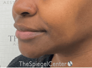 Nasolabial Fold Filler Before & After Gallery - Patient 117666 - Image 4