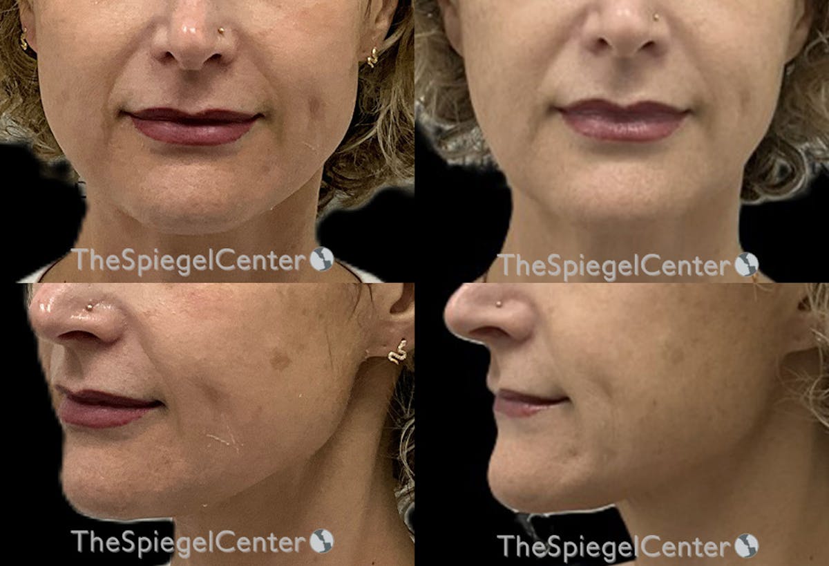 Nasolabial Fold Filler Before & After Gallery - Patient 260504 - Image 1
