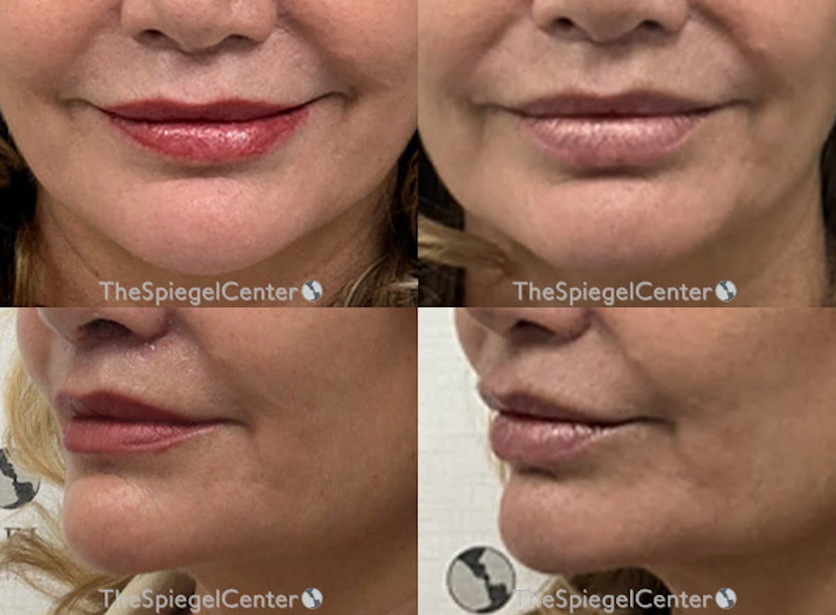 Nasolabial Fold Filler Before & After Gallery - Patient 241420 - Image 1