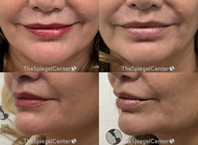 Nasolabial Fold Filler Before & After Gallery - Patient 241420 - Image 1
