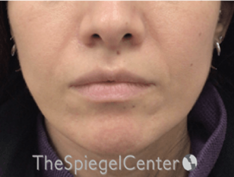 Nasolabial Fold Filler Before & After Gallery - Patient 220666 - Image 1