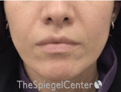 Nasolabial Fold Filler Before & After Gallery - Patient 220666 - Image 1