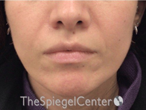 Nasolabial Fold Filler Before & After Gallery - Patient 220666 - Image 1