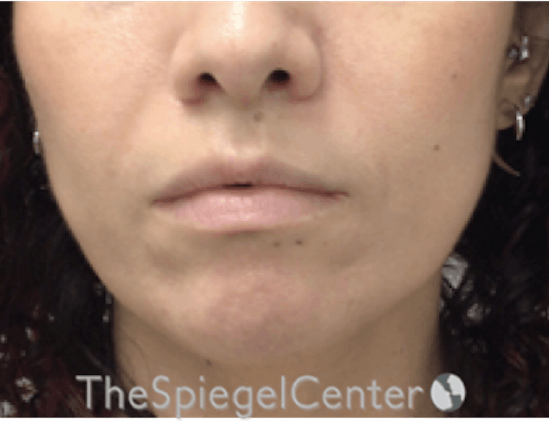 Nasolabial Fold Filler Before & After Gallery - Patient 220666 - Image 2
