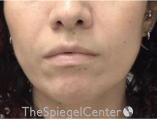 Nasolabial Fold Filler Before & After Gallery - Patient 220666 - Image 2