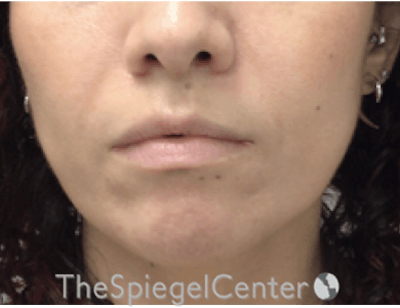 Nasolabial Fold Filler Before & After Gallery - Patient 220666 - Image 2