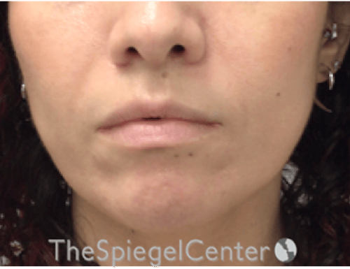Nasolabial Fold Filler Before & After Gallery - Patient 220666 - Image 2