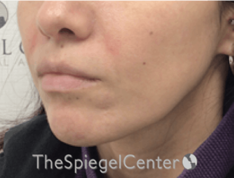 Nasolabial Fold Filler Before & After Gallery - Patient 220666 - Image 3