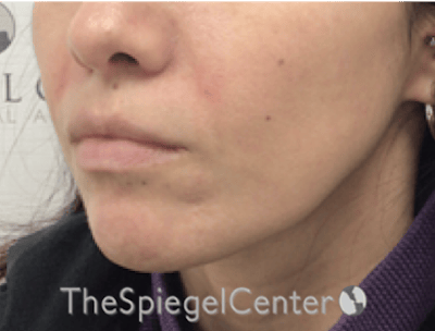 Nasolabial Fold Filler Before & After Gallery - Patient 220666 - Image 3