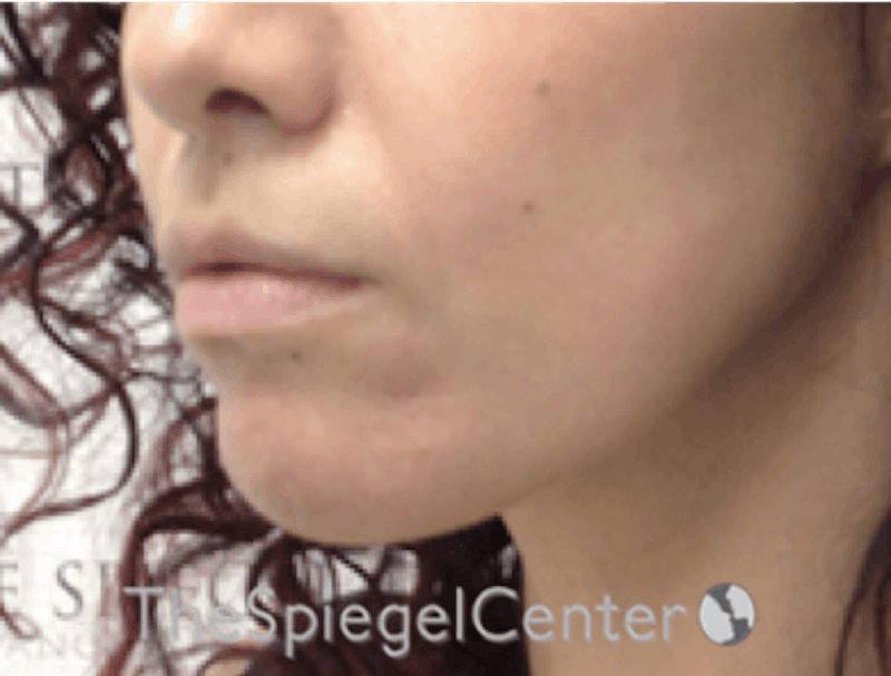 Nasolabial Fold Filler Before & After Gallery - Patient 220666 - Image 4