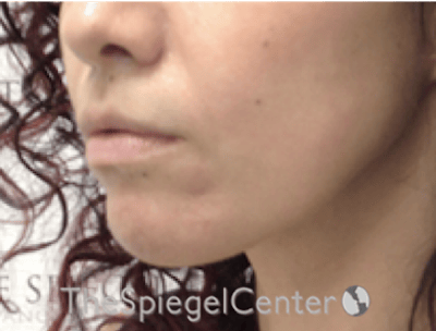 Nasolabial Fold Filler Before & After Gallery - Patient 220666 - Image 4