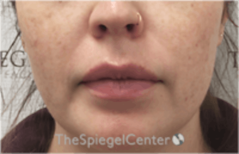 Nasolabial Fold Filler Before & After Gallery - Patient 846726 - Image 1