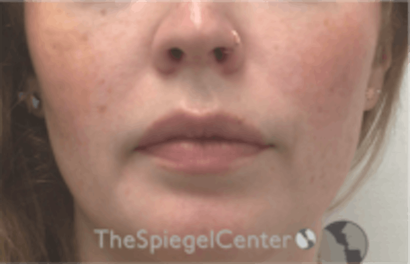 Nasolabial Fold Filler Before & After Gallery - Patient 846726 - Image 2